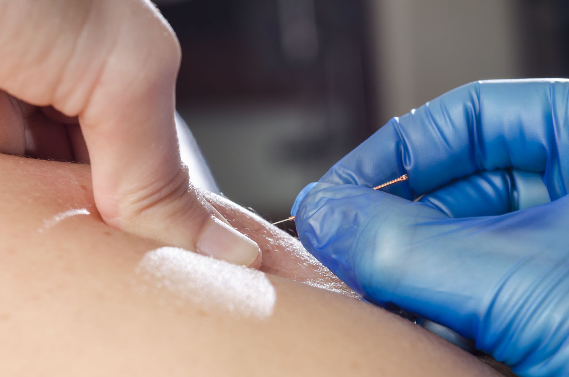 Dry Needling Dry Needling