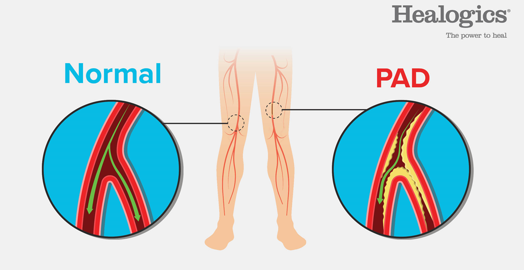Normal artery versus artery in a person with PAD